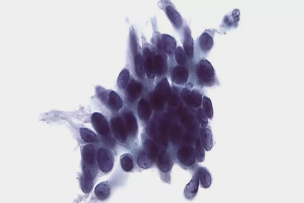 Pap-test-scanning adenokarcinom in situ (CGIN)