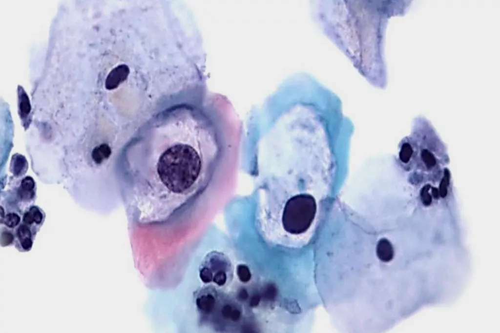 Pap-test-scanning af dyskaryose af lav grad med HPV