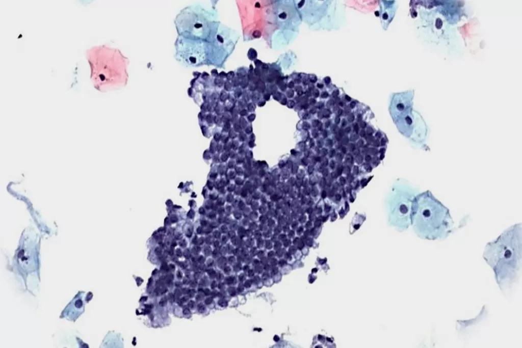 Pap-test-scanning negativ med endocervikale celler