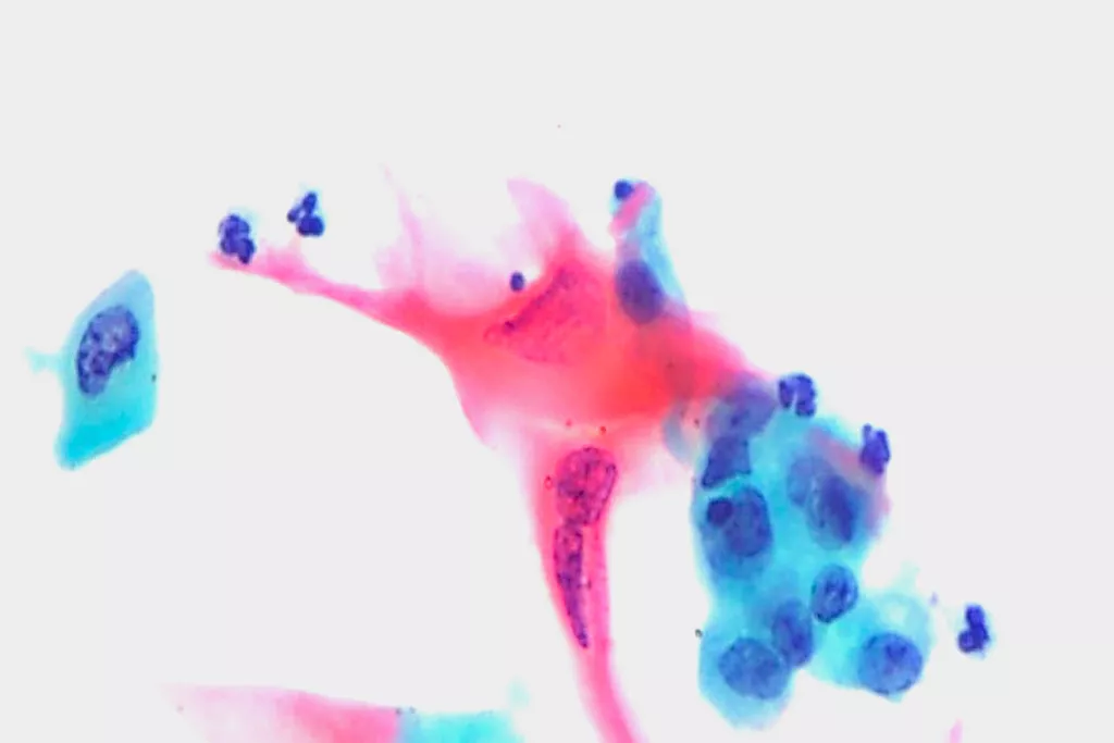 Planocellulært karcinom, urin, PAP-farvning